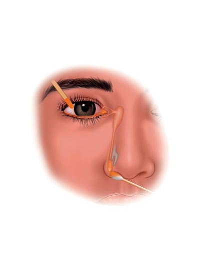 Sac Patency Test (SPT)